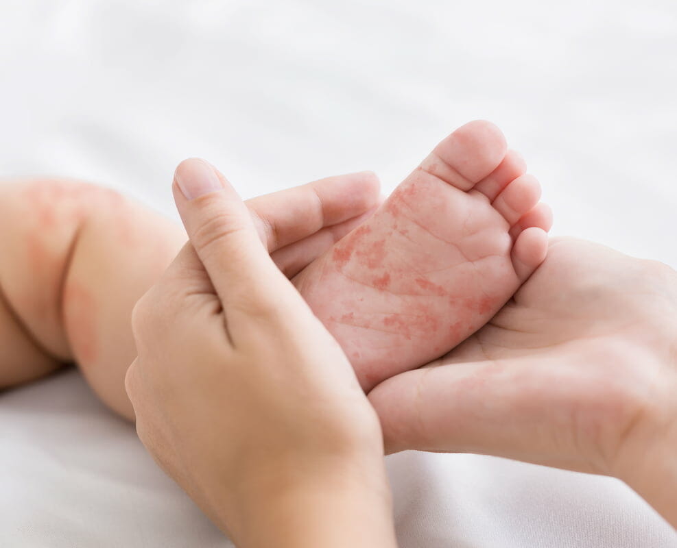 a skin rash on a baby's foot