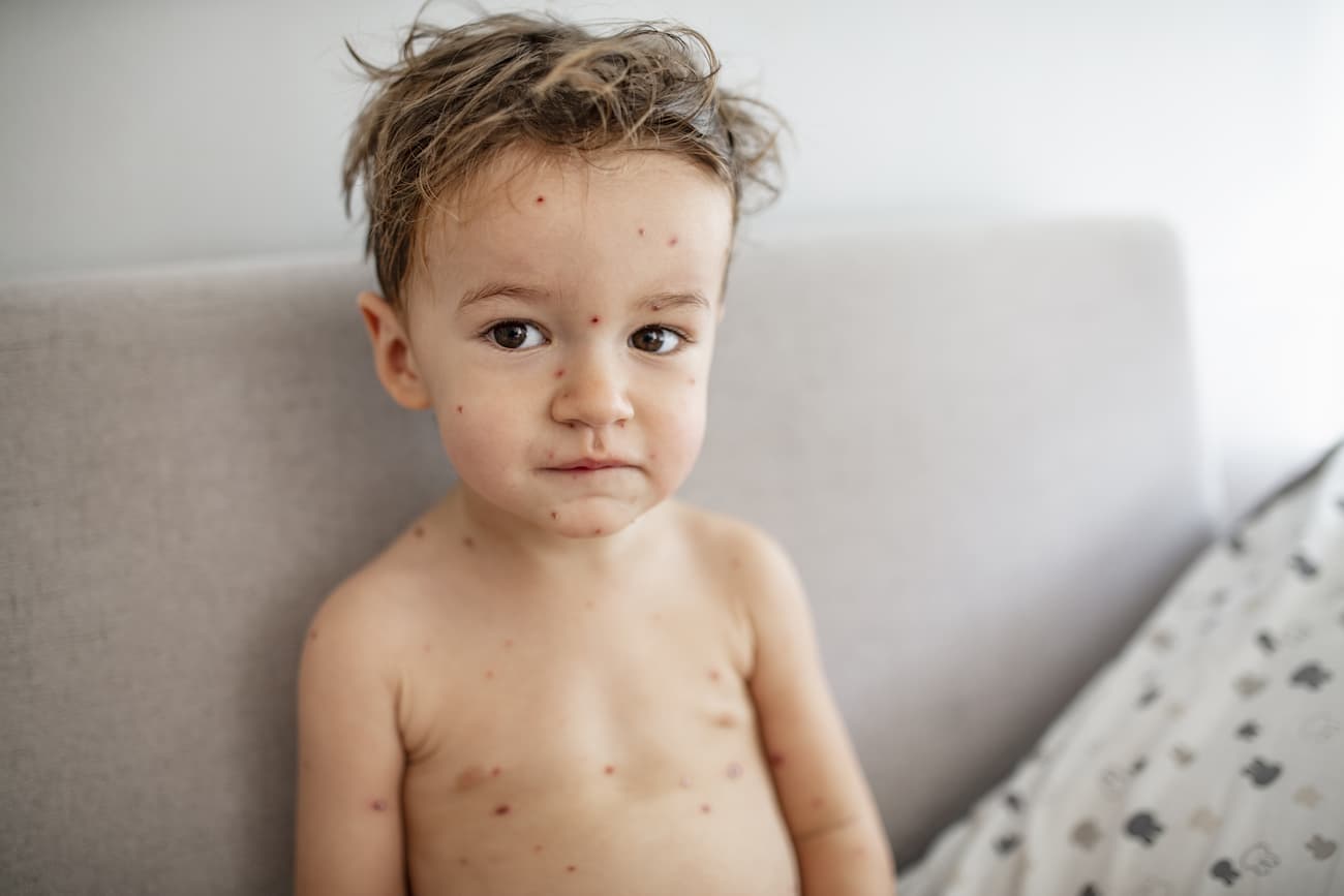 a little boy with chickenpox