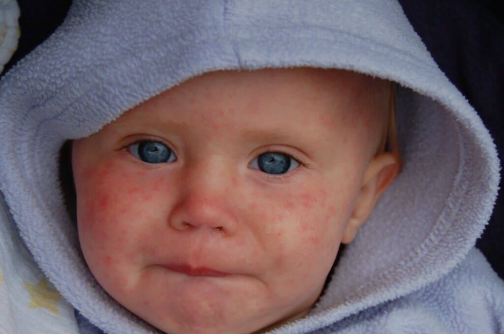 Baby with Measles rash on face