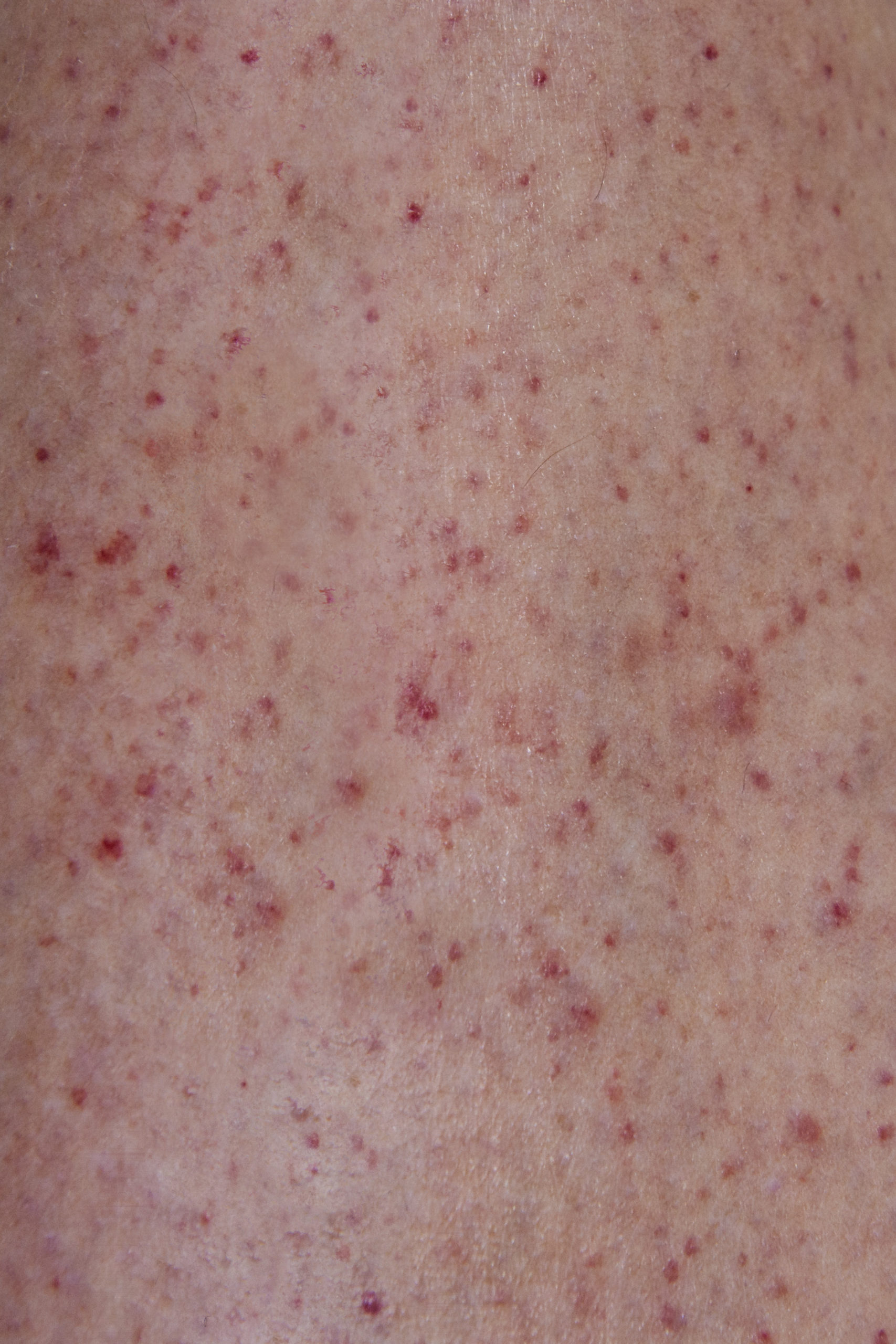 Close Up Image Of Meningitis Rash