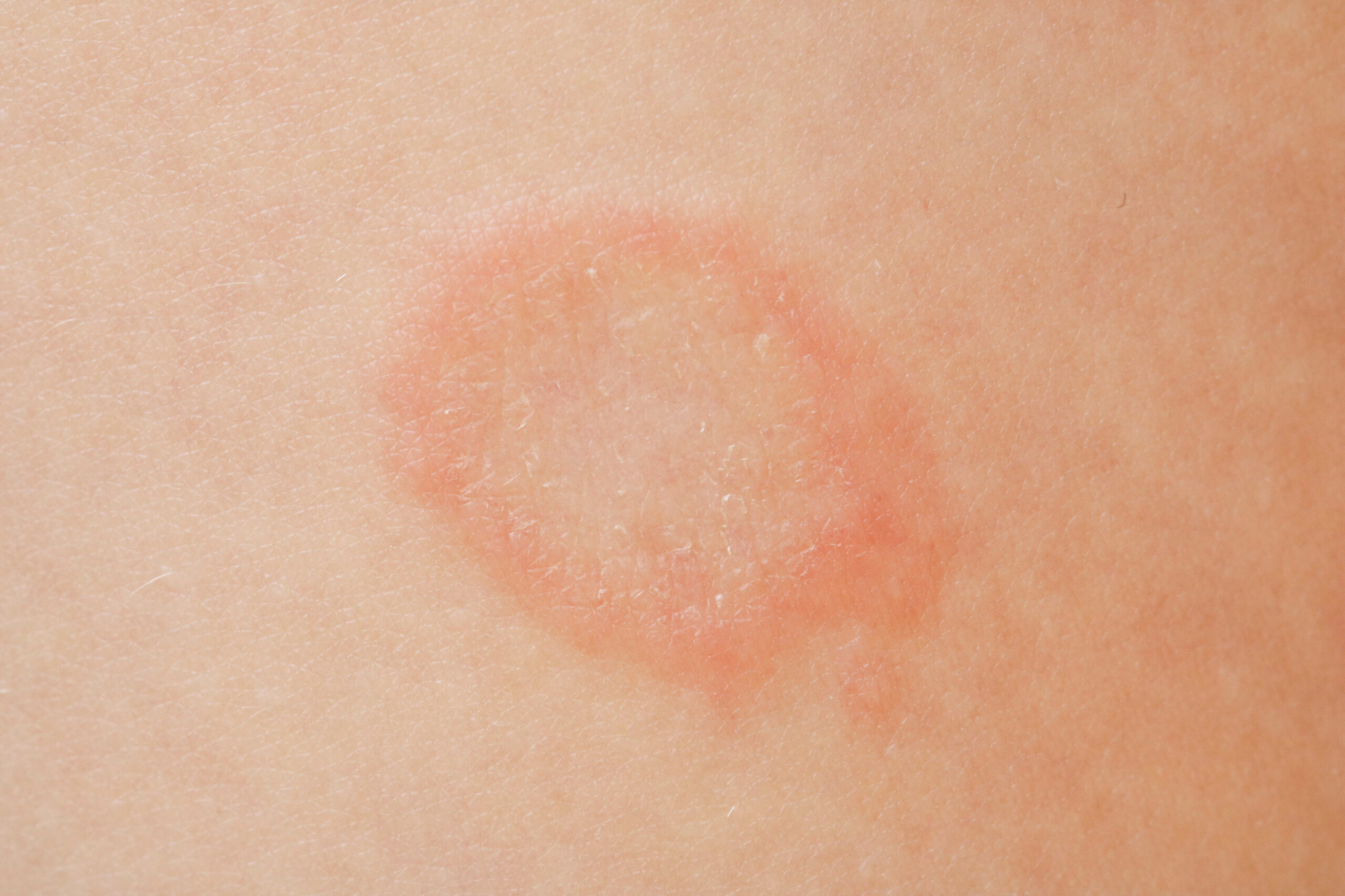 Ringworm on a child's skin. 