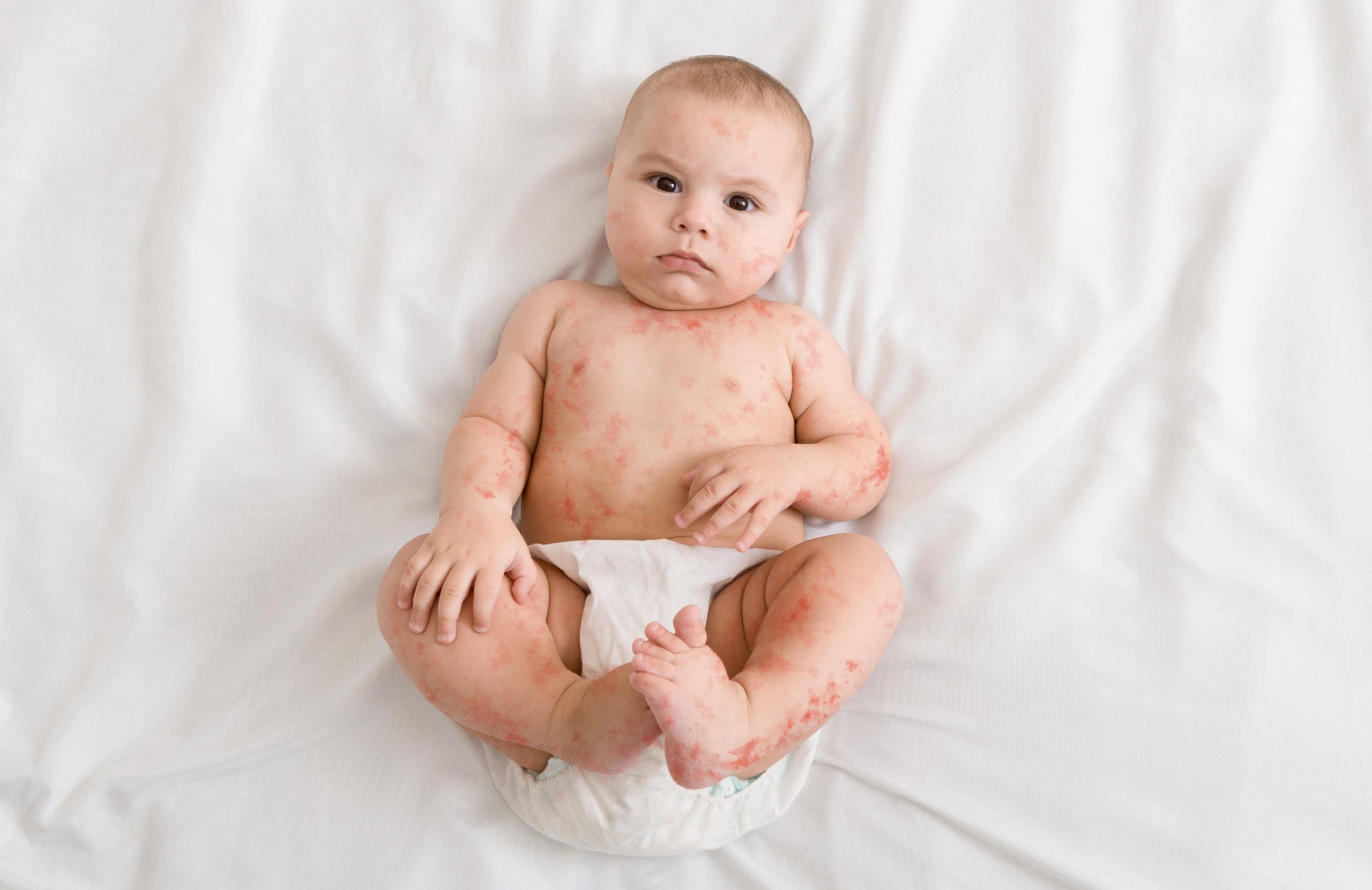 Upset baby with measles rash
