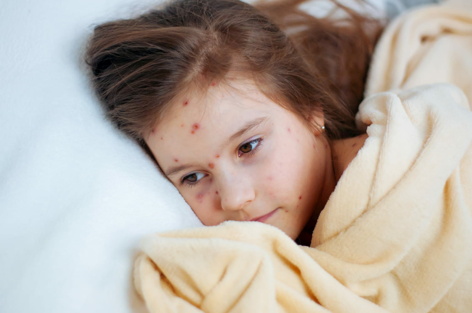 Little girl with chickenpox lying down