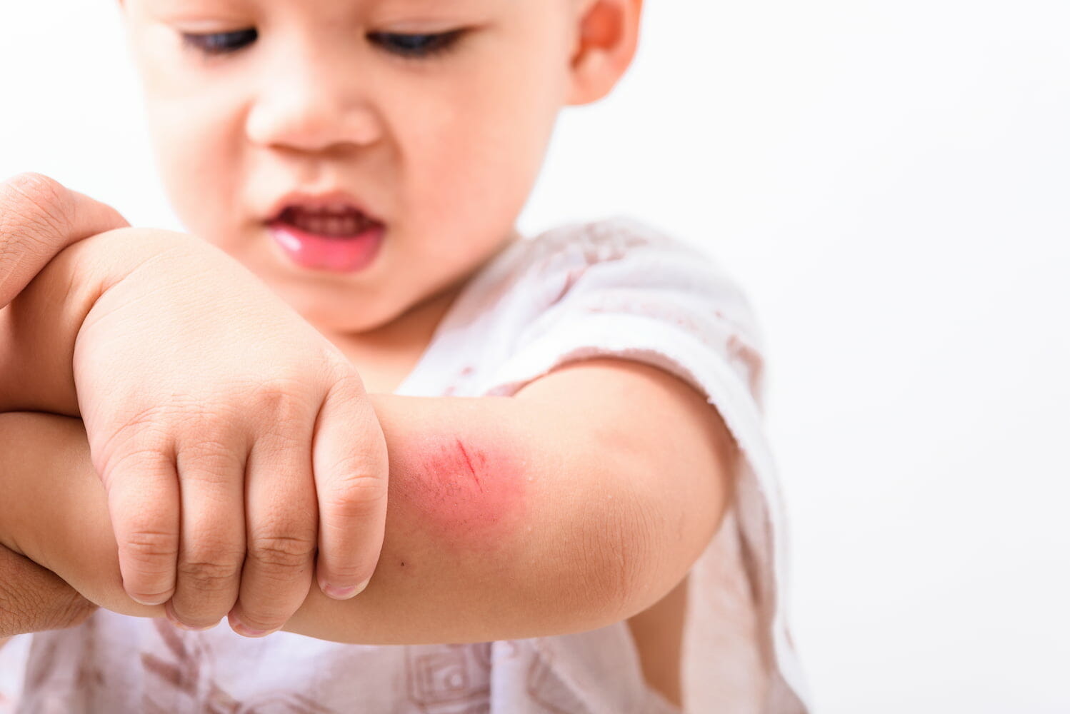 a child holding their grazed elbow