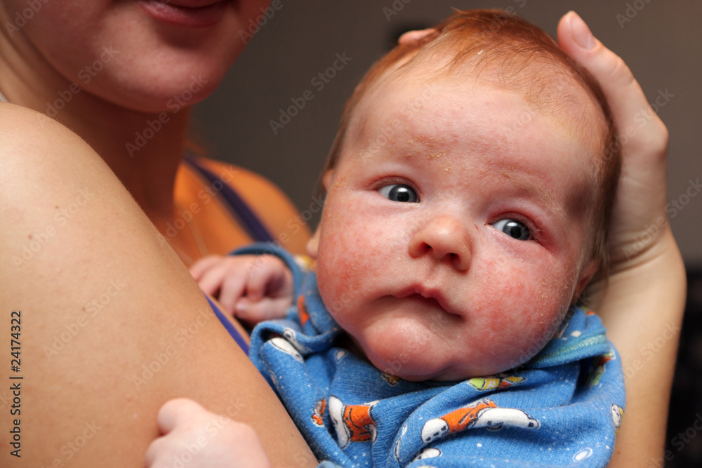 Eczema in an infant
