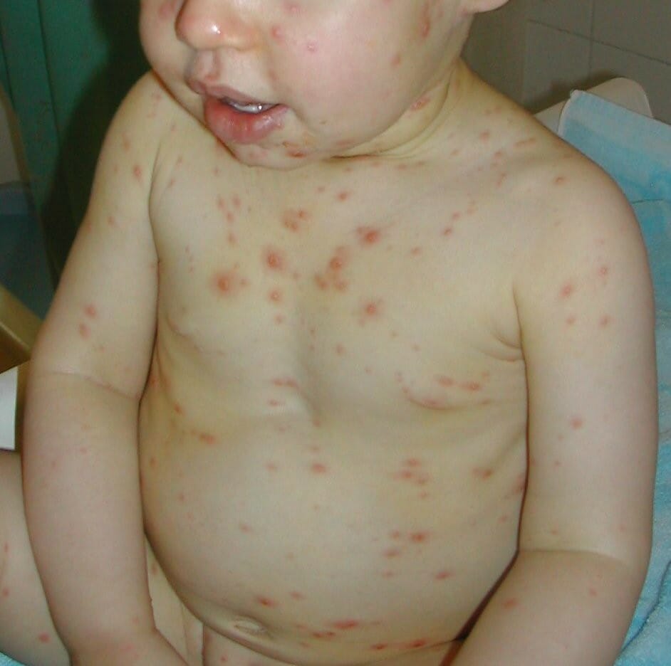 Baby with chickenpox rash all over the body