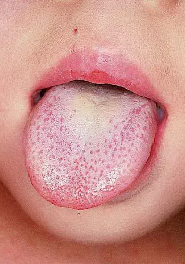 scarlet fever tongue